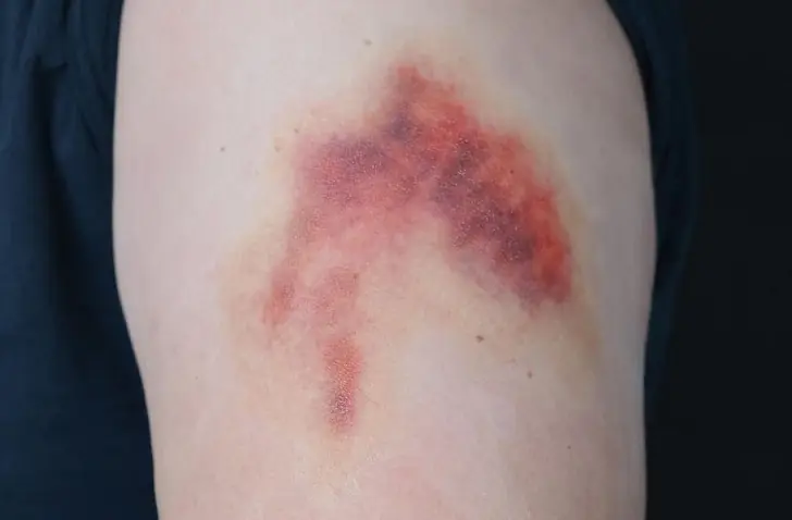 Hematoma vs bruise: Key differences.